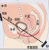 尿失禁治療器（干渉低周波 頻尿・尿失禁治療）原理・病気・効果・副作用｜神戸市東灘区の「いしむら腎泌尿器科」