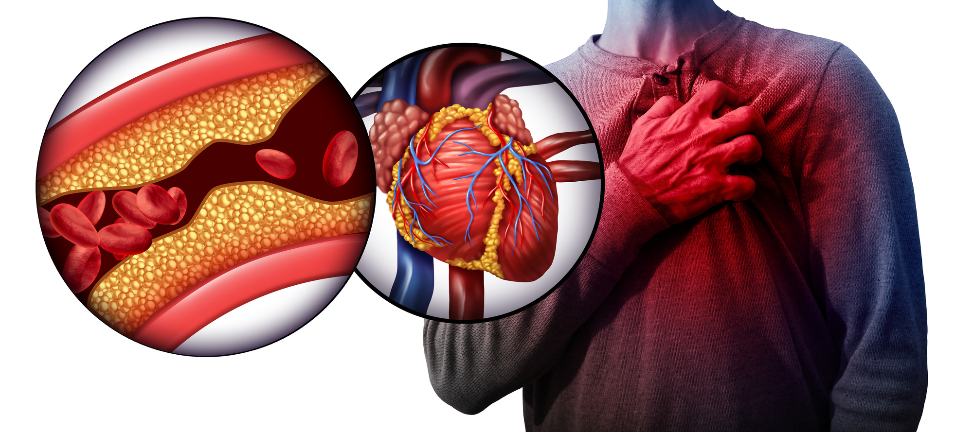 動脈硬化と心筋梗塞
